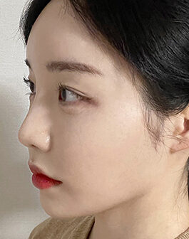 nose thread lift in Korea PangPang Clinic Gangnam