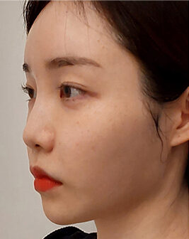 nose thread lift in Korea PangPang Clinic Gangnam