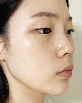 nose thread lift in Korea PangPang Clinic Gangnam