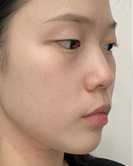 nose thread lift in Korea PangPang Clinic Gangnam