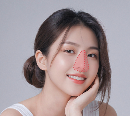 nose thread lift in Korea PangPang Clinic Gangnam 