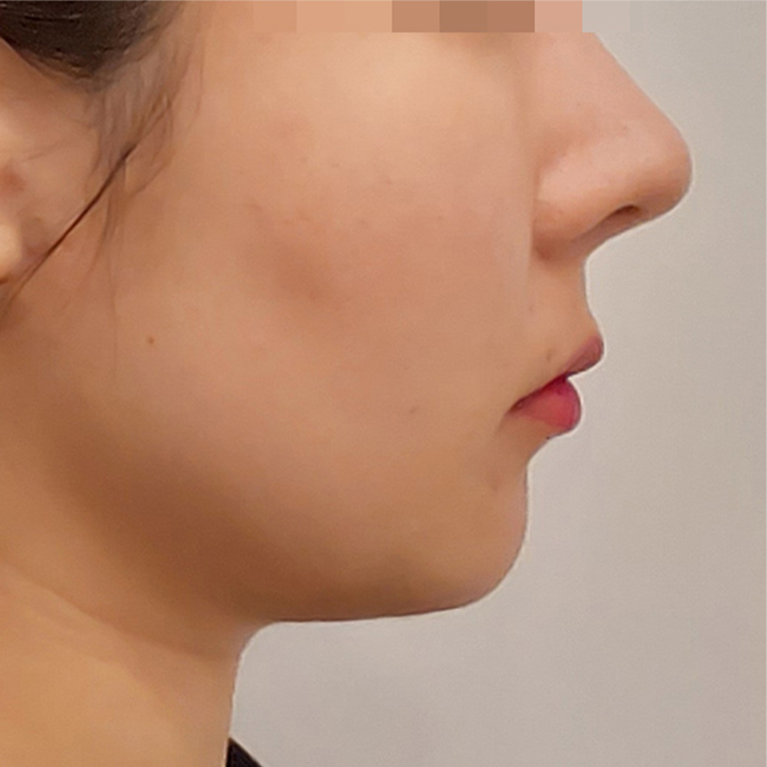 double chin thread lift in Korea PangPang Clinic gangnam