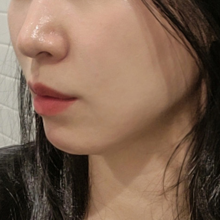 double chin thread lift in Korea PangPang Clinic gangnam