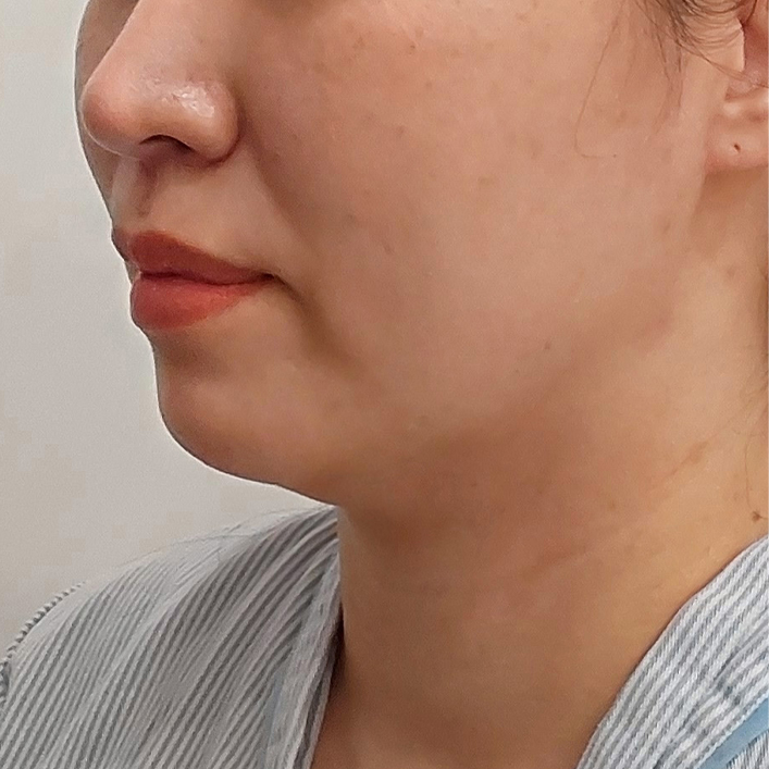 double chin thread lift in Korea PangPang Clinic gangnam