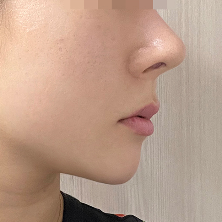 double chin thread lift in Korea PangPang Clinic gangnam