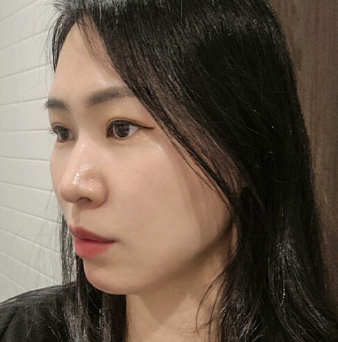 buccal fat thread lift in Korea PangPang Clinic in gangnam