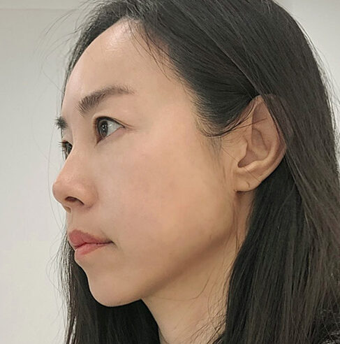 buccal fat thread lift in Korea PangPang Clinic in gangnam