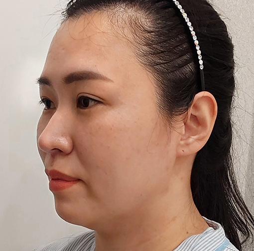 buccal fat thread lift in Korea PangPang Clinic in gangnam