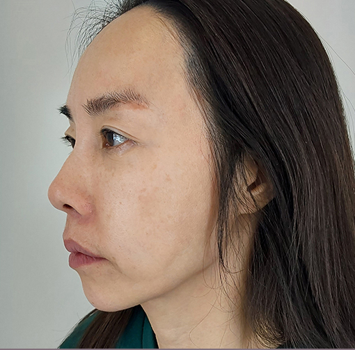 buccal fat thread lift in Korea PangPang Clinic in gangnam