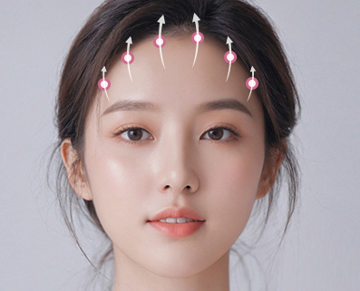 forehead eyebrow thread lift in Korea PangPang Clinic gangnam