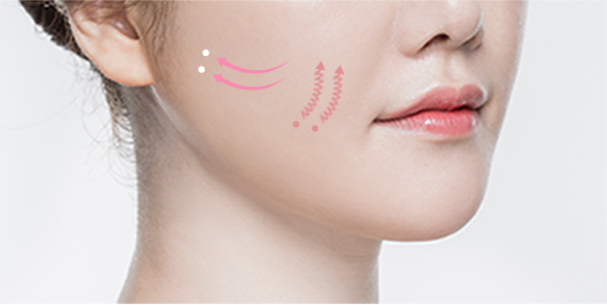 smile line thread lift in Korea PangPang Clinic gangnam