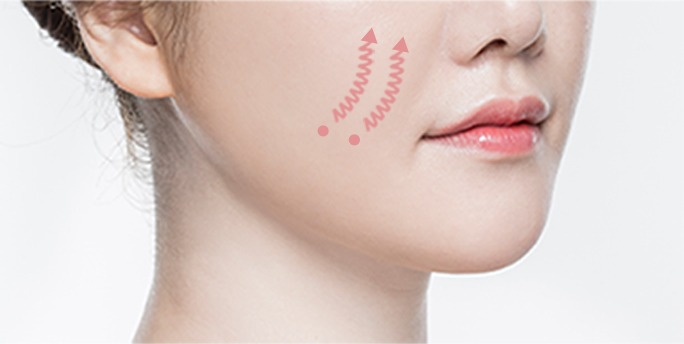 smile line thread lift in Korea PangPang Clinic gangnam