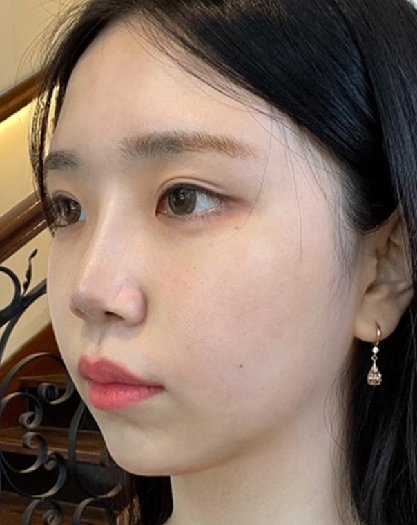 thread lifting in Korea Pangpang clinic Gangnam