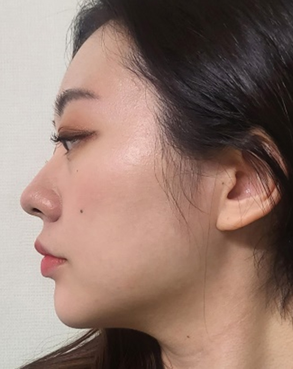thread lifting in Korea Pangpang clinic Gangnam