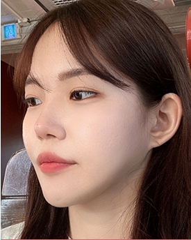 thread lifting in Korea Pangpang clinic Gangnam