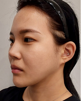 thread lifting in Korea Pangpang clinic Gangnam