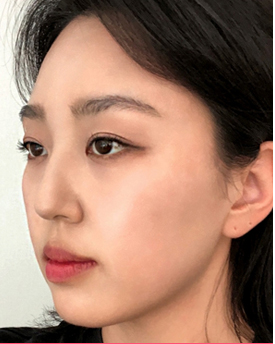 thread lifting in Korea Pangpang clinic Gangnam