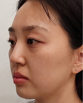 thread lifting in Korea Pangpang clinic Gangnam