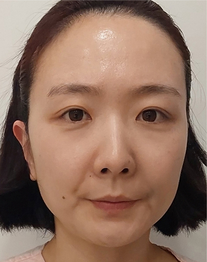 thread lifting in Korea Pangpang clinic Gangnam