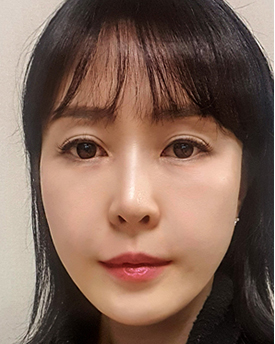 thread lifting in Korea Pangpang clinic Gangnam