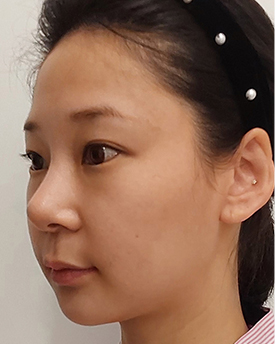 thread lifting in Korea Pangpang clinic Gangnam
