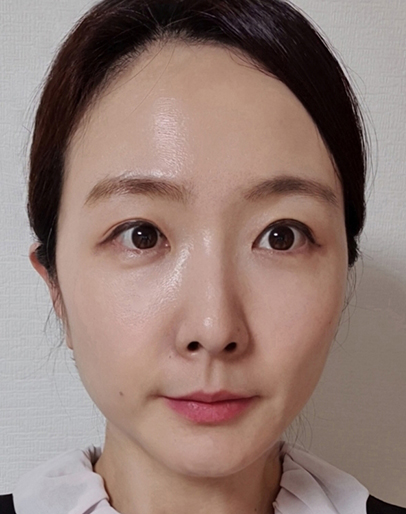 thread lifting in Korea Pangpang clinic Gangnam