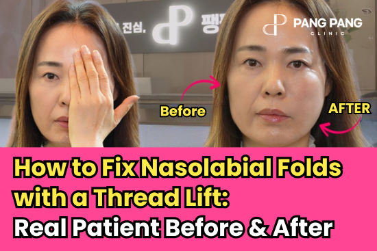 How to Fix Nasolabial Folds with a Thread Lift: Real Patient Before & After