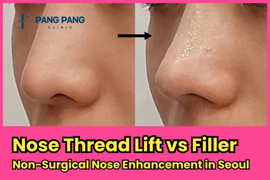 Non-Surgical Nose Enhancement in Seoul: Nose Thread Lift vs Filler — Guide for Medical Travelers