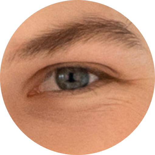 male thread lift in Korea pangpang clinic Seoul gangnam