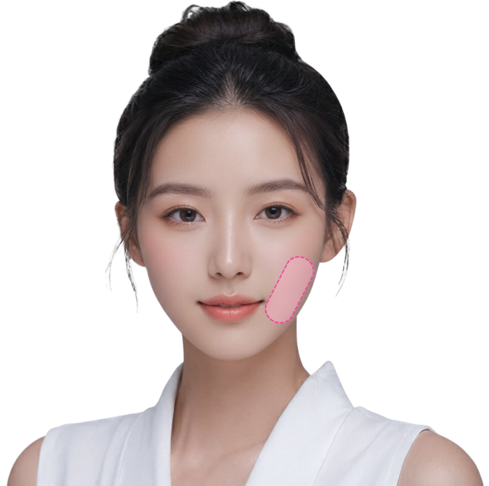 buccal fat thread lift in Korea PangPang Clinic in gangnam