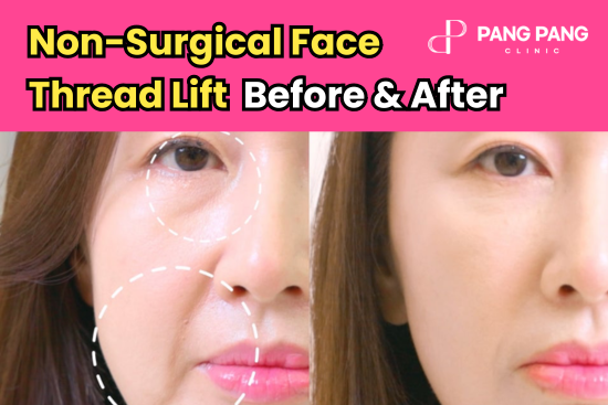 Non-Surgical Face Thread Lift Before & After in Korea: Soften Nasolabial Folds & Under‑Eye Hollows